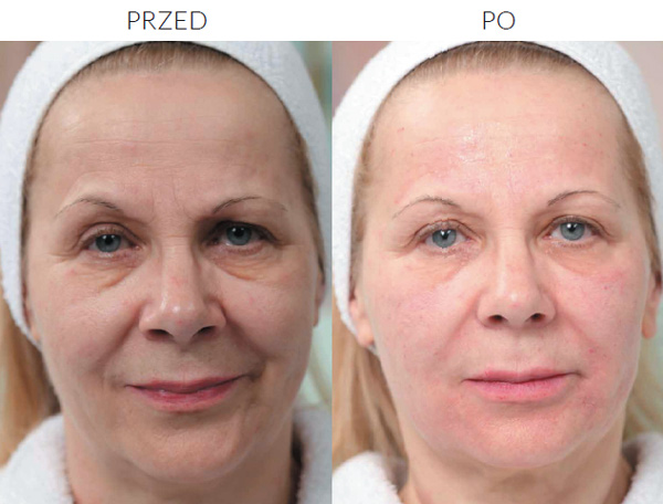 Efekty zabiegu mezoterapii z zastosowaniem preparatu CytoCare S Line (fot. Beautymed.pl)