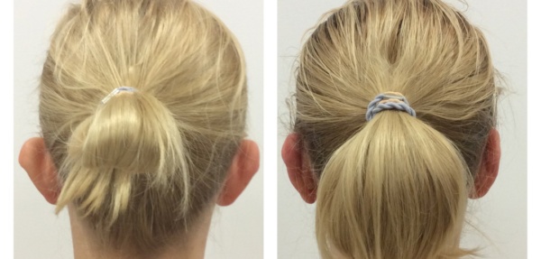 Korekta uszu bez skalpela - przed i po zabiegu