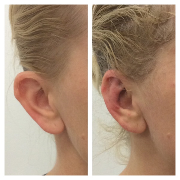 Korekta uszu bez skalpela - przed i po zabiegu