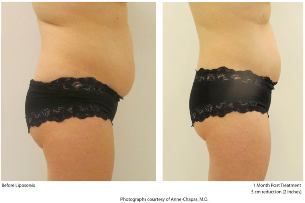 Liposonix