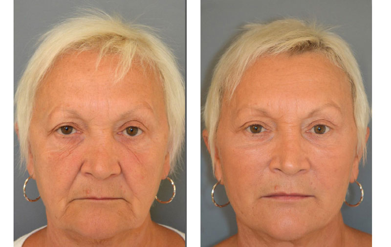 Lifting nićmi przed po