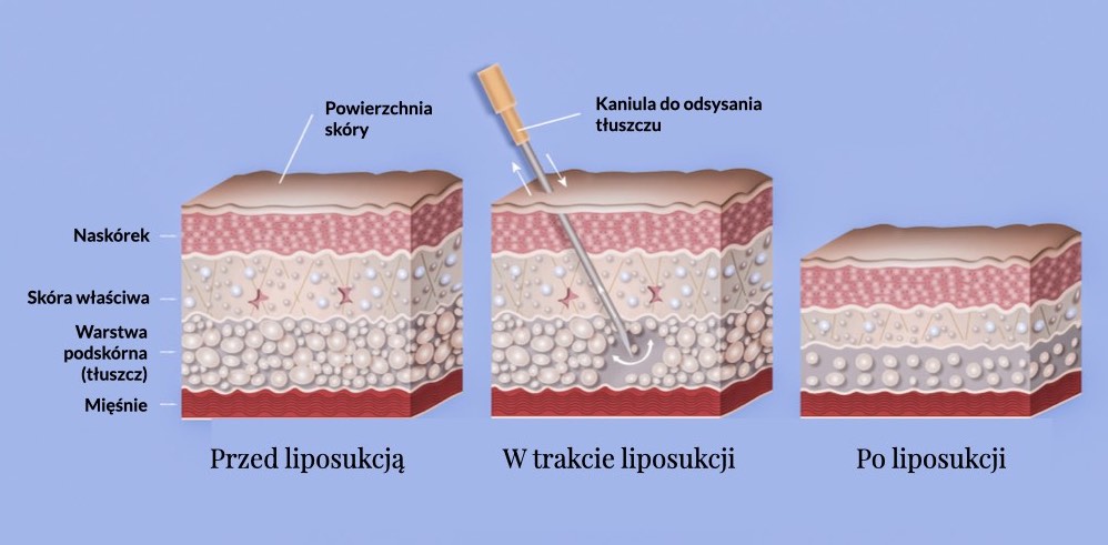 na czym polega liposukcja - WirtualnaKlinika.pl