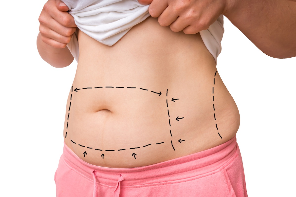 liposukcja brzucha i boczków